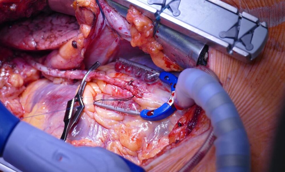 Beating Heart (Off-Pump) Bypass Surgery