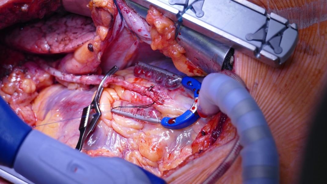 Beating Heart (Off-Pump) Bypass Surgery