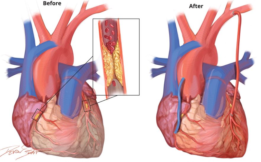 Coronary Artery Bypass Surgery (CABG)