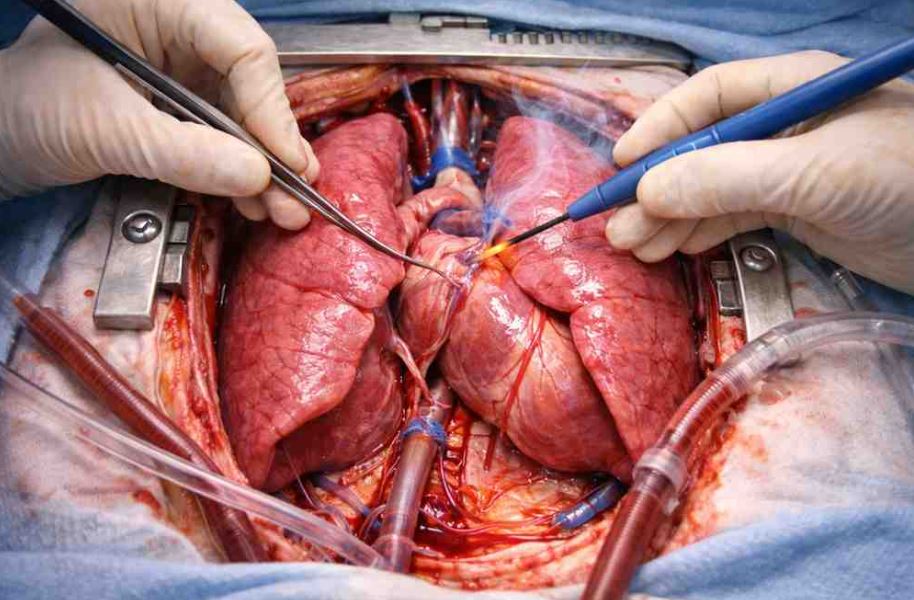 Thoracic Surgery (Decortication, Lobectomy, Pneumonectomy)